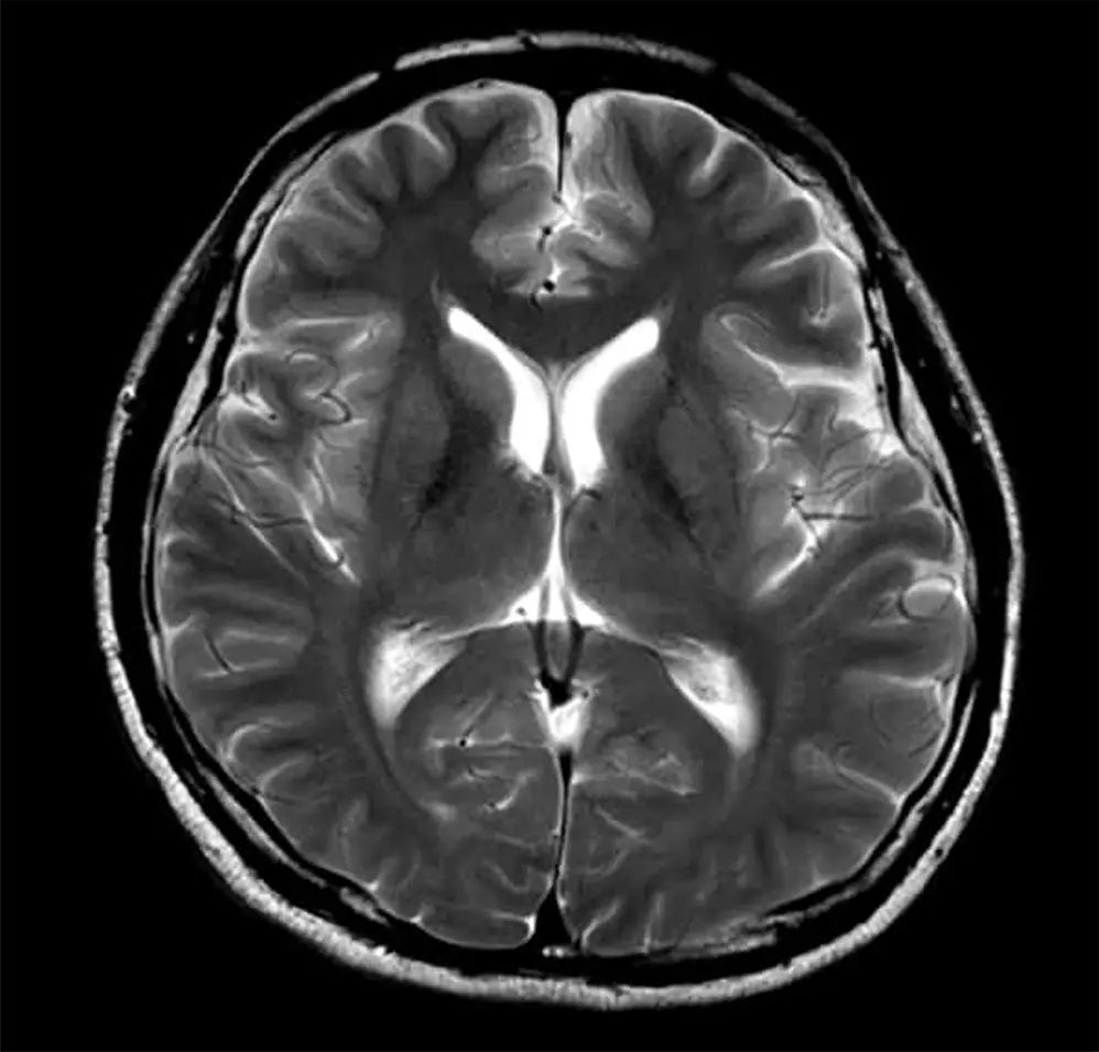 MRI／T2強調画像による病変の早期発見