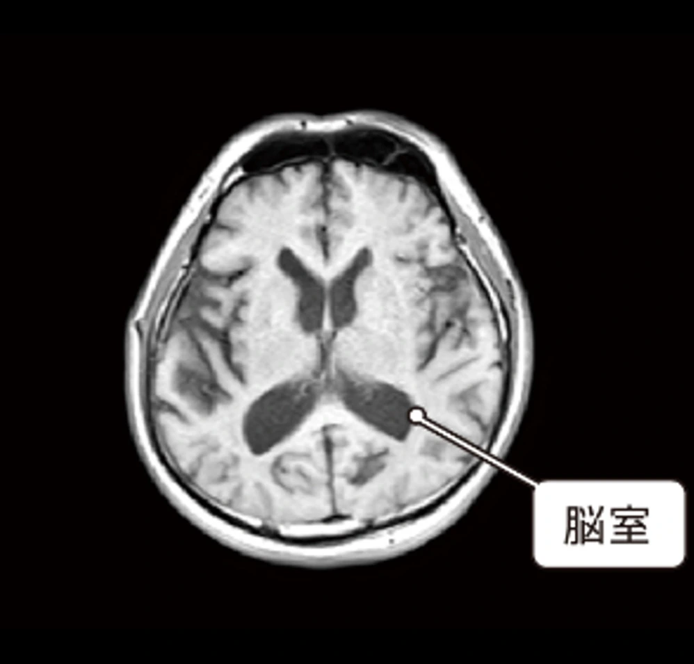 脳の萎縮
