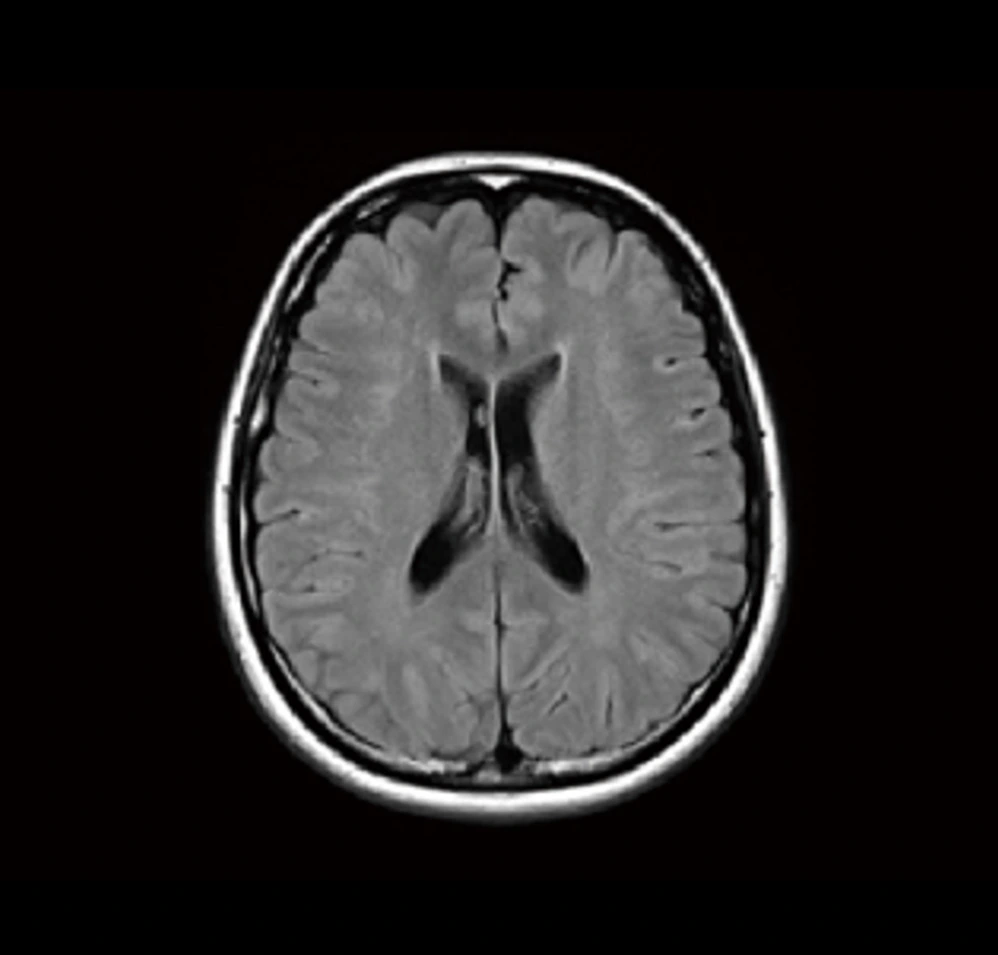 脳に現れる白い斑点