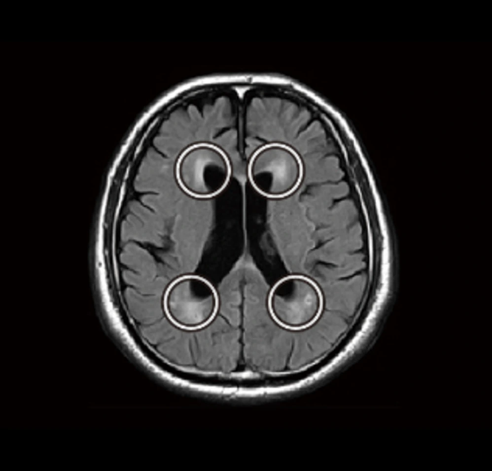 脳に現れる白い斑点