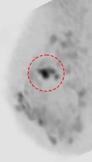 乳房DWIBS（痛くないMRI乳がん検診）