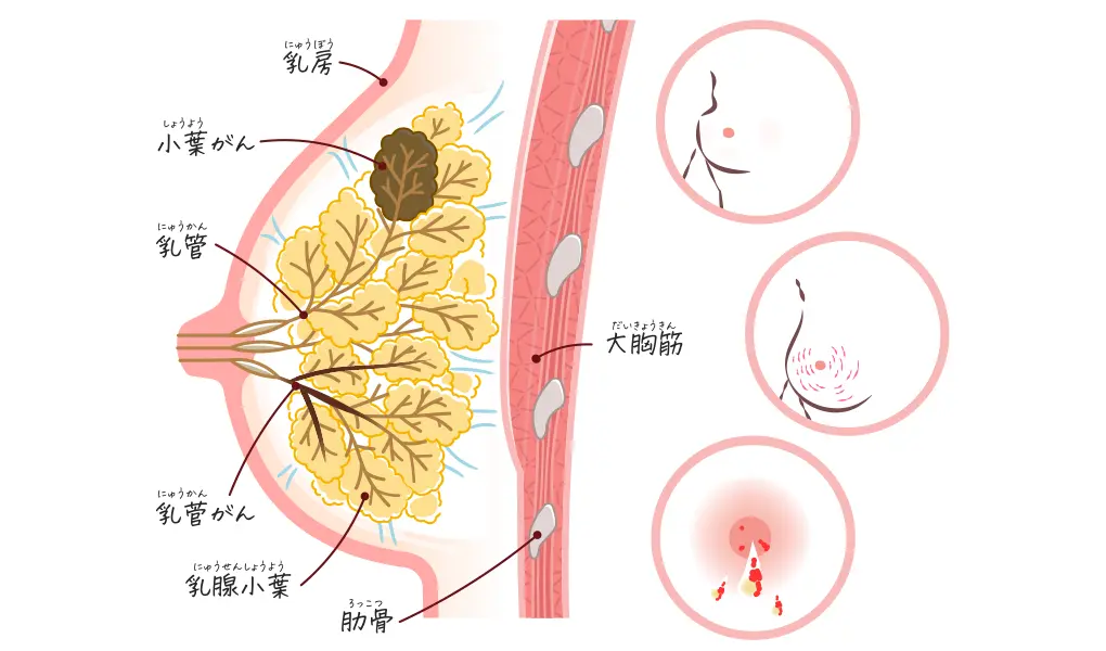 乳がんとは
