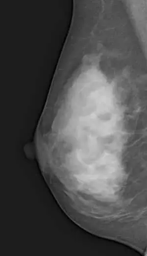 マンモグラフィー