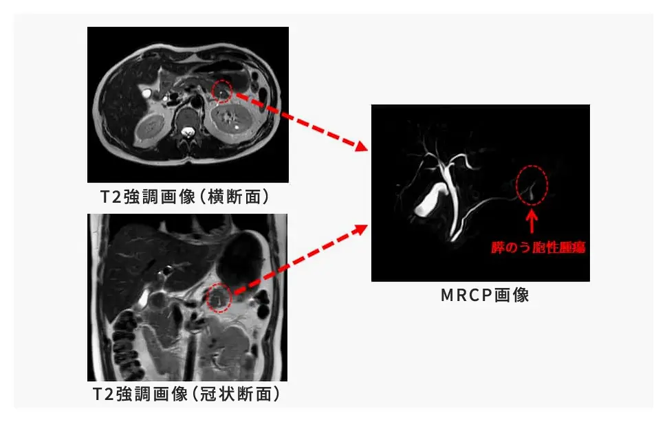 MRCP（MR胆管膵管撮影）