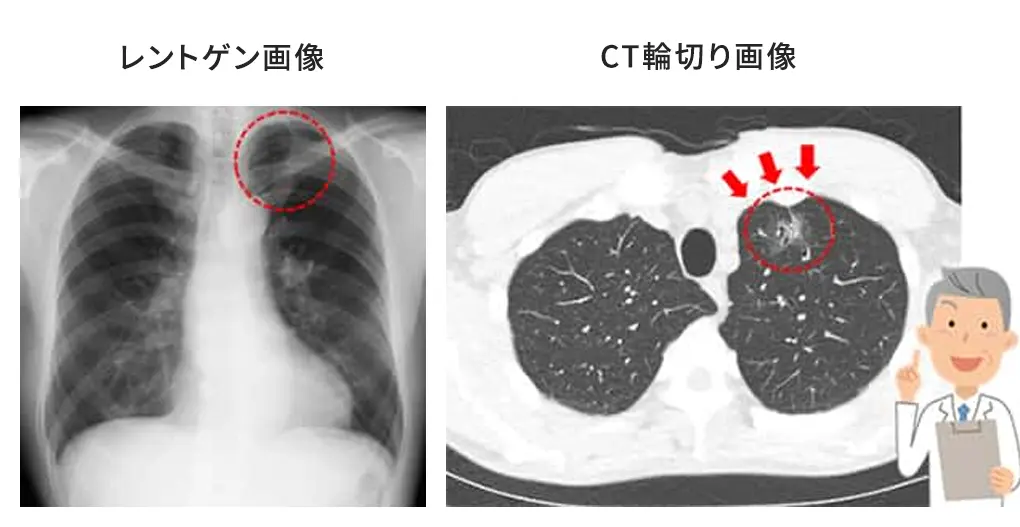 超低被ばくCTとは？