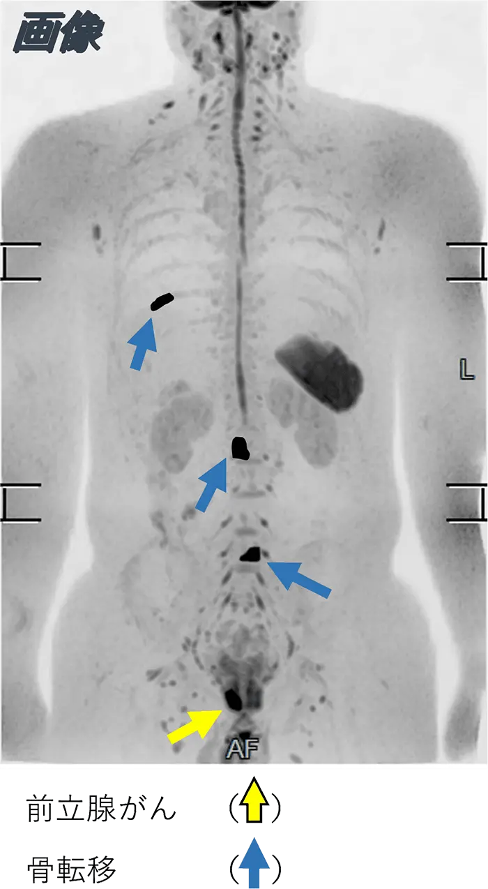 どのようにがんがわかるの？