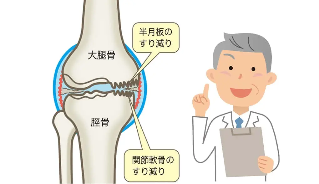 膝関節に起こりやすい病気