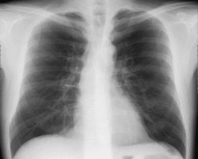 レントゲン画像：正面