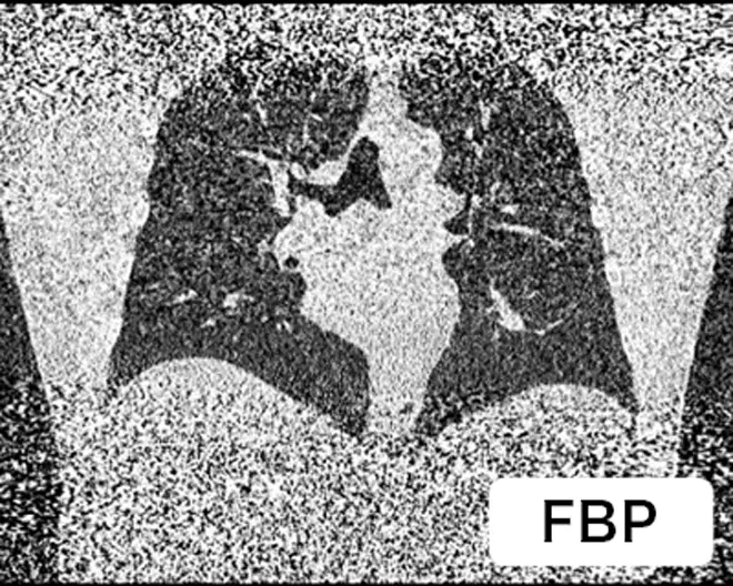 従来の処理での胸部CT撮影