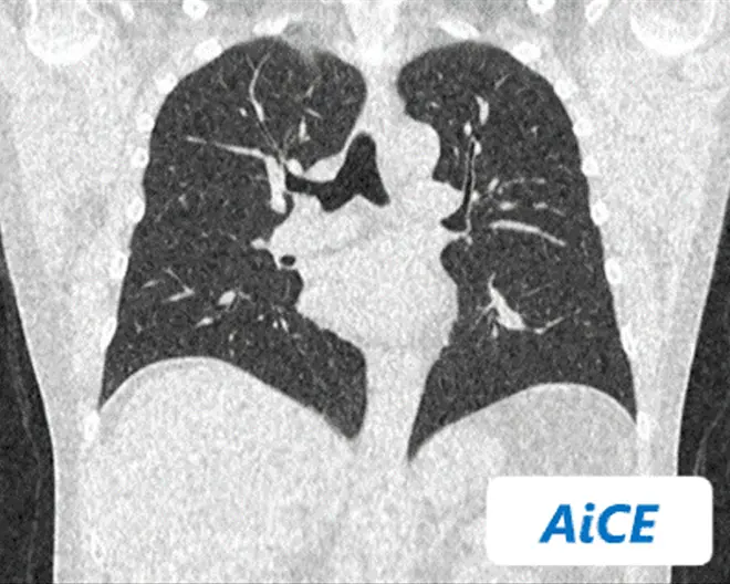 AiCEで処理した胸部CT撮影