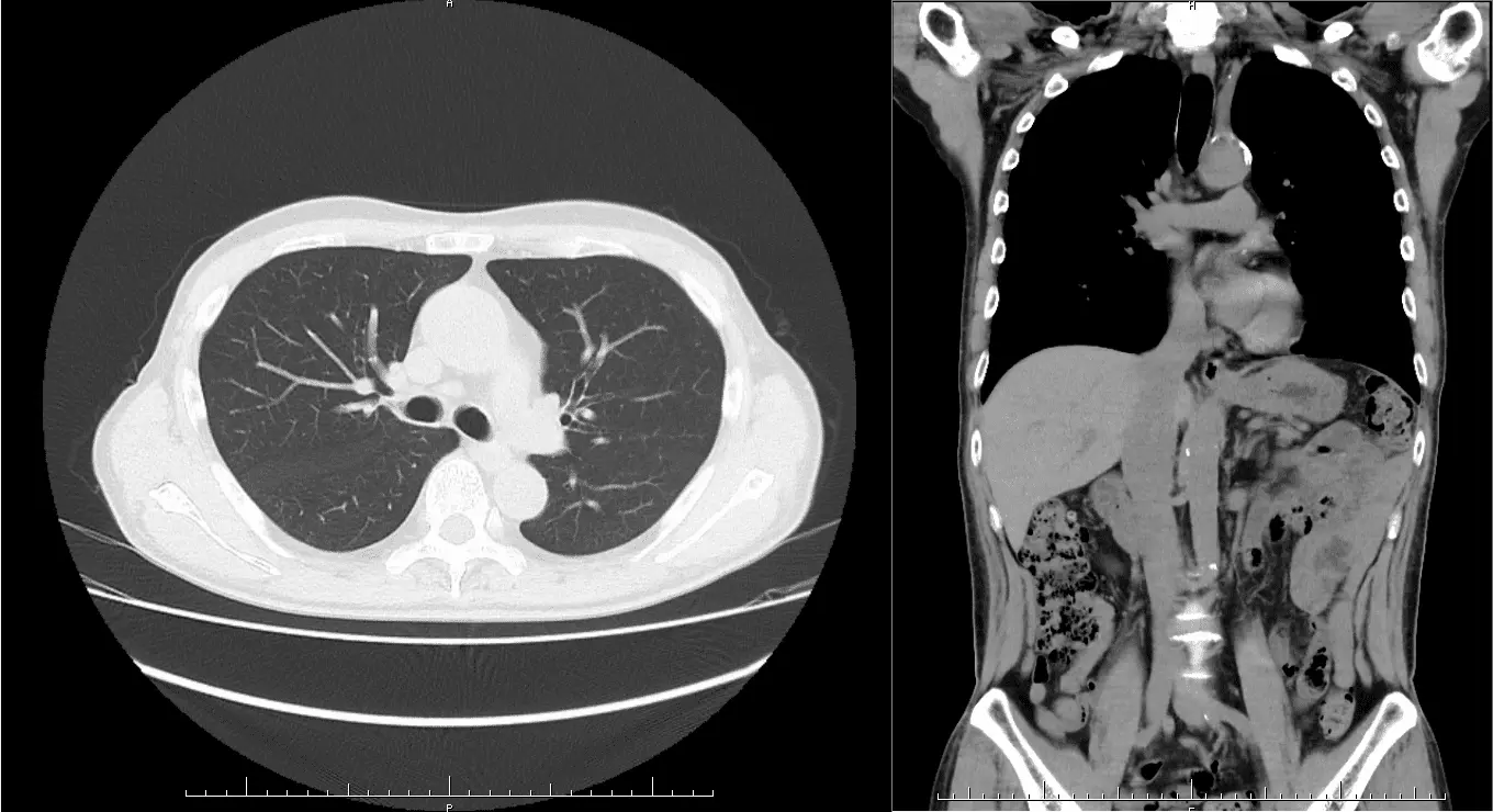 胸腹部CTで肺や腹部臓器の病気、フレイルの早期発見をサポート